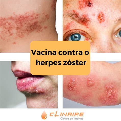 Vacina contra o herpes zóster Clinaire Clínica de vacinação e