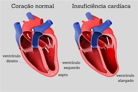 Insuficiência cardíaca causas sintomas estágios Brasil Escola