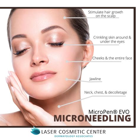 Everything You Need To Know About Microneedling With Prp Laser