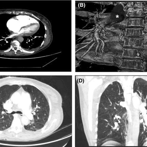 Patients Computed Tomography Pulmonary Angiogram With Download