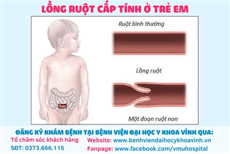 Bệnh Lồng Ruột Ở Trẻ Em Nguyên Nhân Triệu Chứng Và Phương Pháp Điều