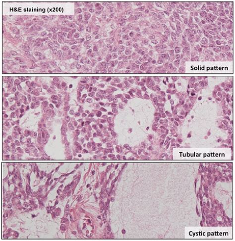 H E Staining X Magnification Demonstrating Solid Tubular And