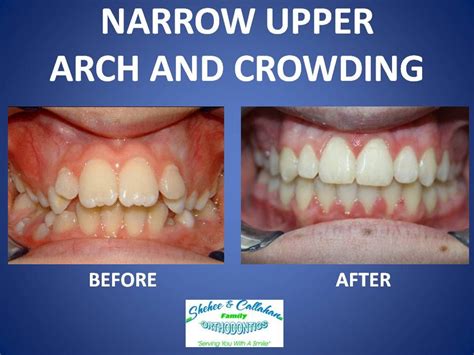 Braces Before And After Narrow Upper Arch And Crowding Invisalign