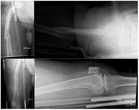 Radiographs Demonstrating An Acute Atypical Mid Shaft Right Download Scientific Diagram