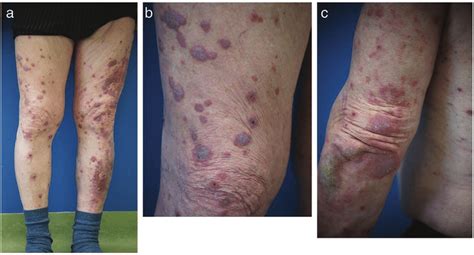 Symmetrically Distributed Violaceous Papules And Plaques Predominantly