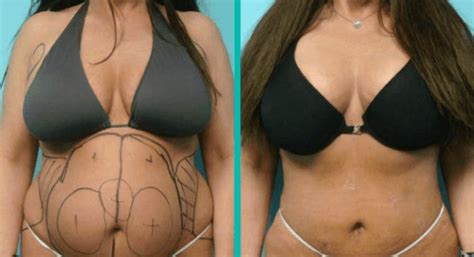 Lipoaspiração Antes e Depois Quanto Custa Dicas