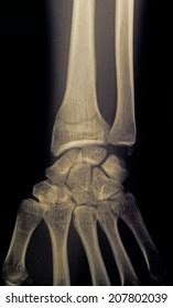 Film Xray Wrist Show Fracture Distal Stock Photo Shutterstock