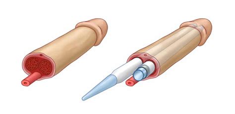 Protese Peniana Pre O E Como Funciona Cirurgia Impotencia