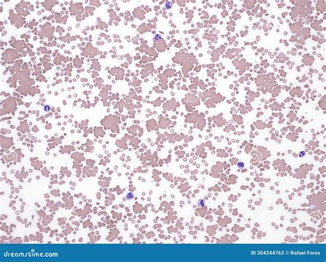 Red Cell Agglutination In A Patient With Cold Agglutinin Disease Stock