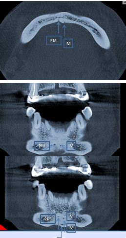 Lingual Foramen