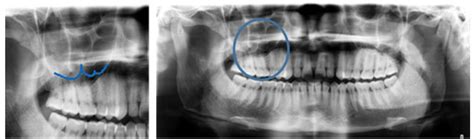 Panoramic Radiograph Showing Septa In Maxillary Sinus Download