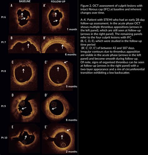 Serial Optical Coherence Tomography Imaging Of ACS Causing Culprit