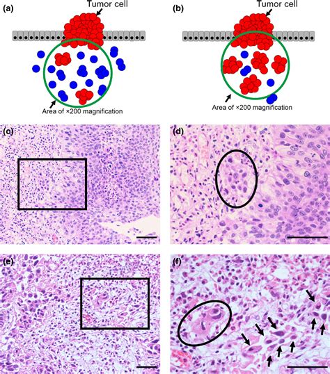 Tumor Budding A Novel Prognostic Indicator For Predicting Stage