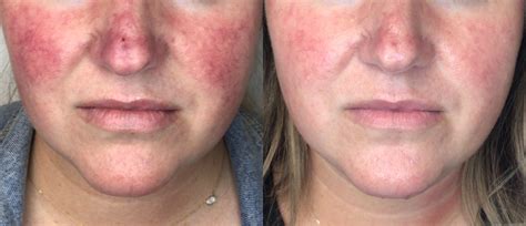 Lumecca Ipl Treatment Before And After Tampa Fl