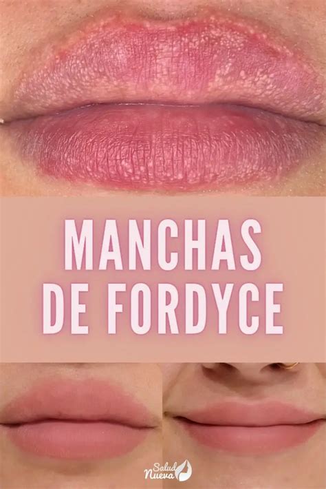 Manchas De Fordyce Que Son