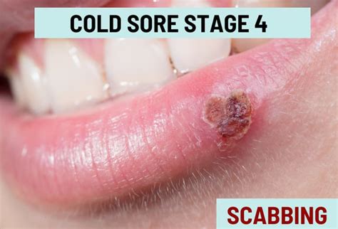 Cold Sore Stages With Pictures