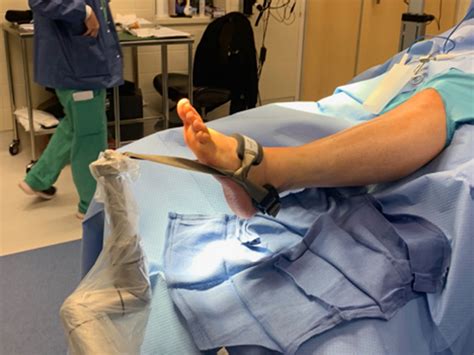 One Step Distraction Technique Using Trimano Fortistm Arm In Ankle