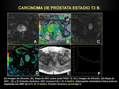 CARCINOMA DE PRÓSTATA ESTADIO T3 B ppt descargar