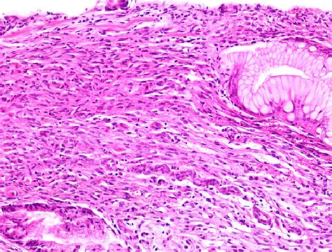 Gastric Kaposi Sarcoma Tumor Composed Of Intersecting Fascicles Of