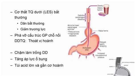 Chẩn đoán và điều trị GERD Trào ngược dạ dày thực quản YouTube