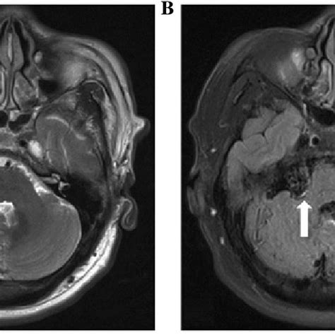 A T2 Weighted Axial Mri And B T1 Weighted Axial Mri Showing