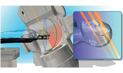 HyperArc Technology for High-Definition Radiotherapy and Radiosurgery | Varian