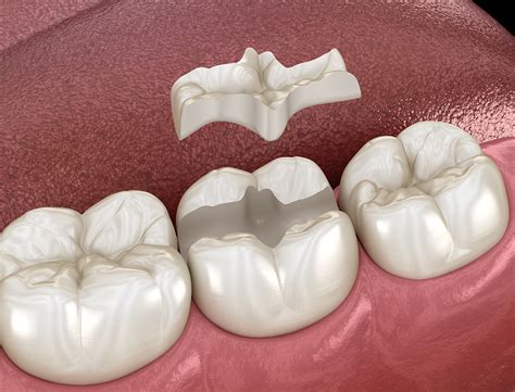 Porcelain Inlays and Onlays - Greeson Dentistry