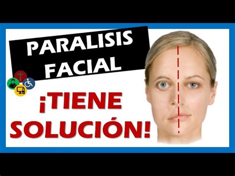 Ejercicios Faciles Para Paralisis Facial Off