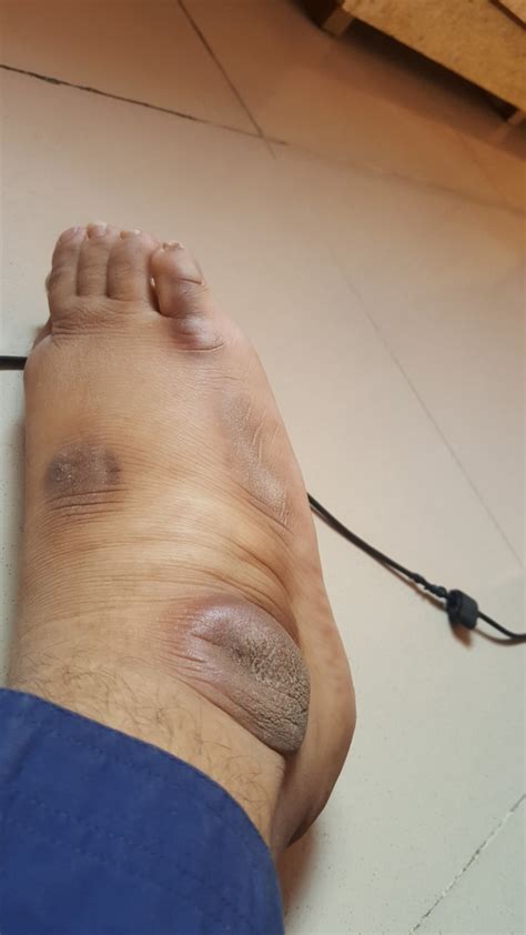 Black Mark On Foot Heel Online Emergencydentistry