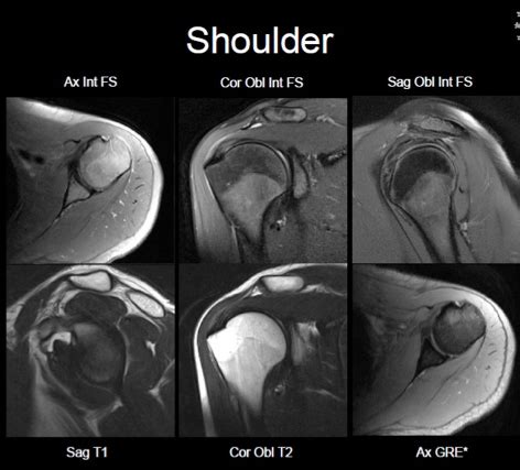 Mri Shoulder Dislocation