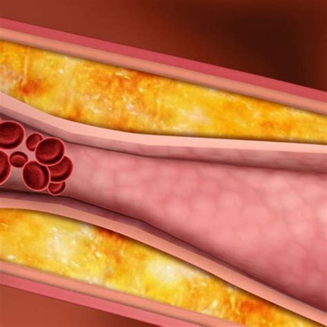 Dislipidemias Archivos Salud LTS