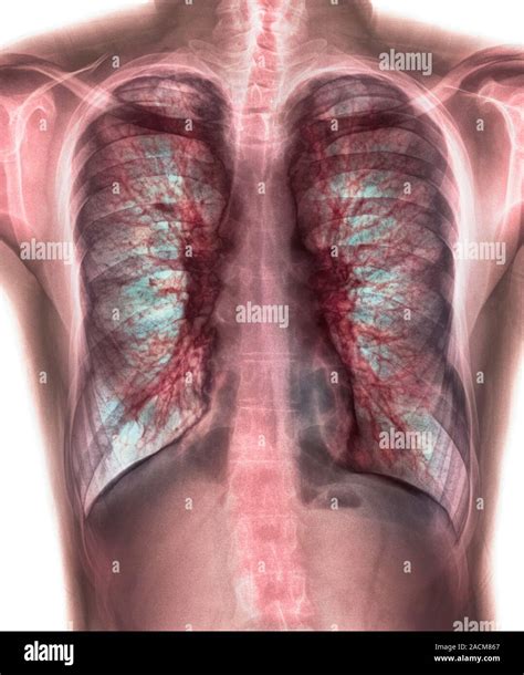 Coloured Chest X Ray Front View Showing Mucus In The Lungs In A 28