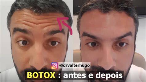 Botox Aplica O Botox Antes Depois Dr Valter Hugo Youtube