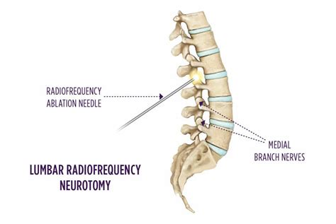 Lumbar Medial Branch Rf Neurotomy Summit Orthopedics