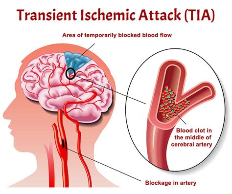 Transient Ischemic Stroke Symptoms