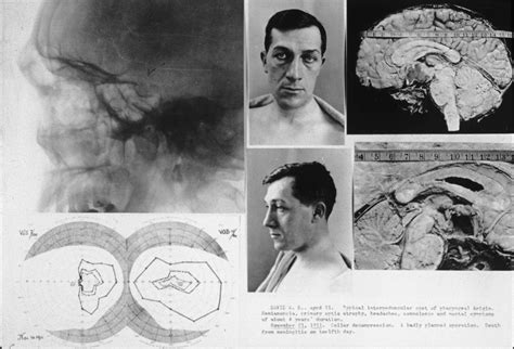 Craniopharyngioma The Neurosurgical Atlas By Aaron Cohen Gadol M D