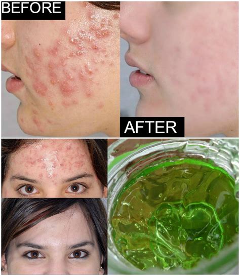 Home Remedy For Acne And Pimples How To Get Rid Of Acne