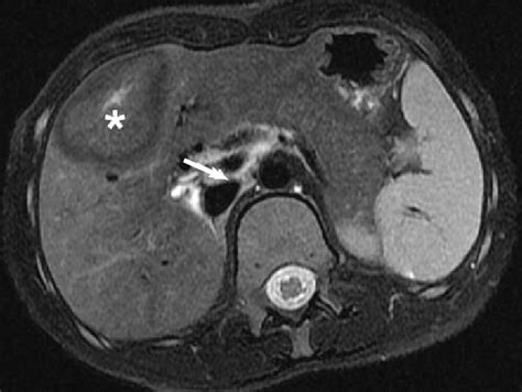 Congenital Absence Of The Portal Vein The Splanchnic Vein Joins The