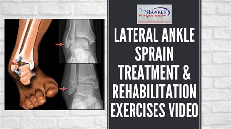 Lateral Ankle Sprain Treatment And Rehabilitation Exercises Video