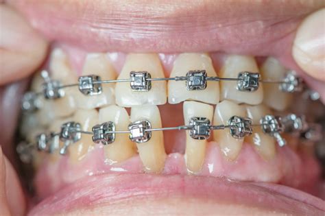 Stained Teeth After Braces