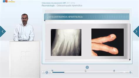 Ct Vuelta Reumatologia Otros Youtube