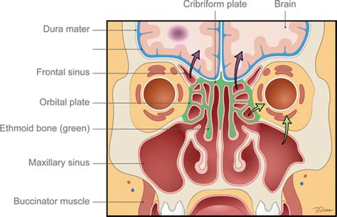 Deadly Fungi Invasive Fungal Rhinosinusitis In The Head And Neck Radiographics