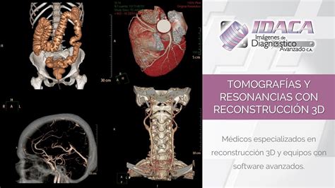 Tomografías Y Resonancias Con Reconstrucción 3d Idaca