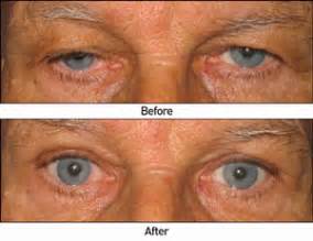 Ptosis West Des Moines | Eyelid Surgery Des Moines | Des Moines Eye