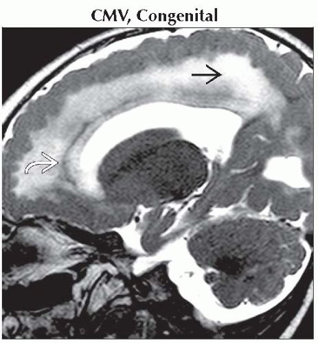 Periventricular Calcification Neupsy Key