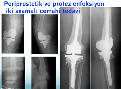 Diz Protezi Revizyonu