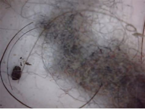 Morgellons Disease Aspergillus Fumigatus And V Fend Vs Noxafil Pro