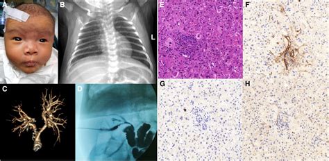 Frontiers Case Report Novel Jag1 Gene Mutations In Two Infants With