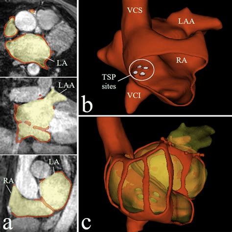 A Segmentation Yellow Of The Left Atrium La Left Atrial Appendage Download Scientific