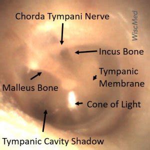 Illustrated Intro To Middle Ear Anatomy As Seen By Otoscopy Wiscmed